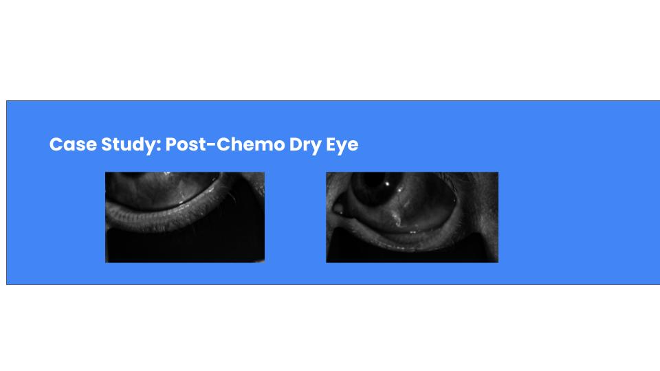 Case Study: Managing Severe Gland Loss Post-Chemotherapy