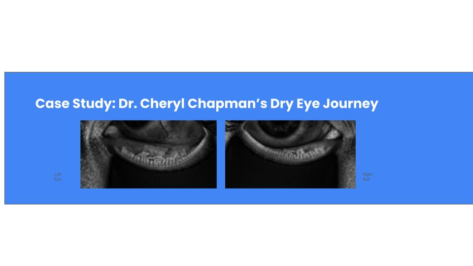 Dr. Cheryl Chapman's Personal Dry Eye Case Study