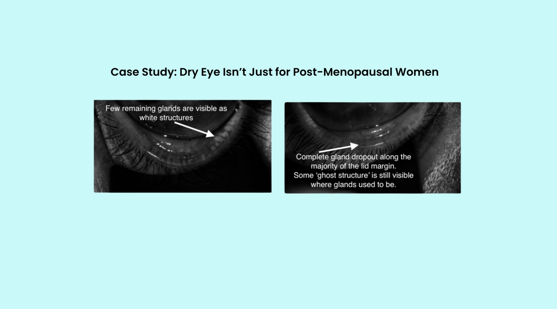 Dry Eye Isn’t Just for Post-Menopausal Women