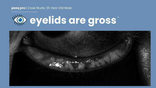 Case Study: Debunking the Myth: MGD and Dry Eye Occur in Men Too