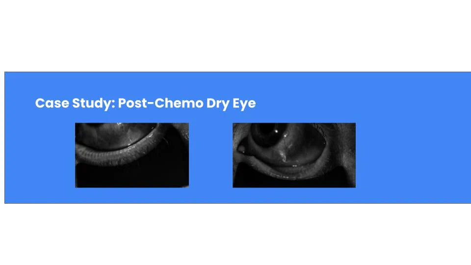 Severe Dry Eye After Chemotherapy: What Helped One Patient Recover