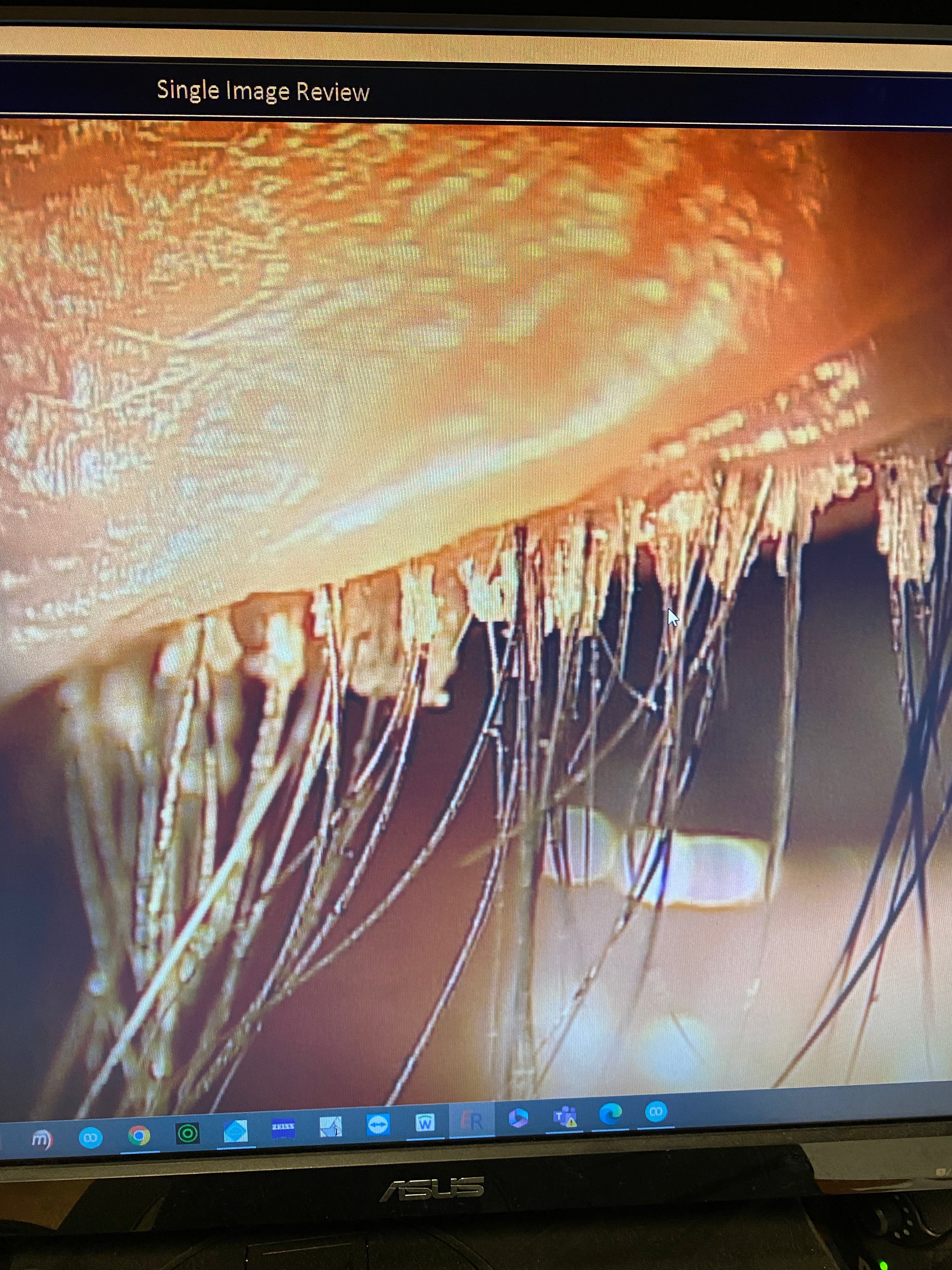 What Do Eyelash Mites Look Like? Signs, Symptoms & When to Treat Demod ...