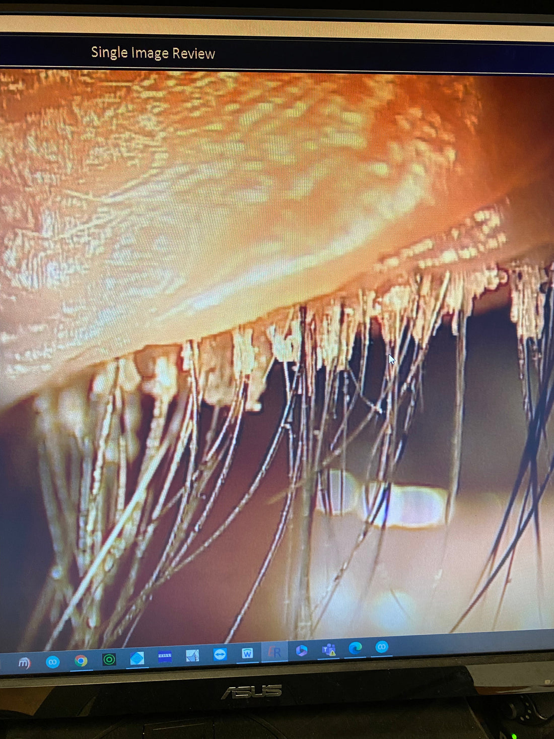 demodex buildup on eyelids